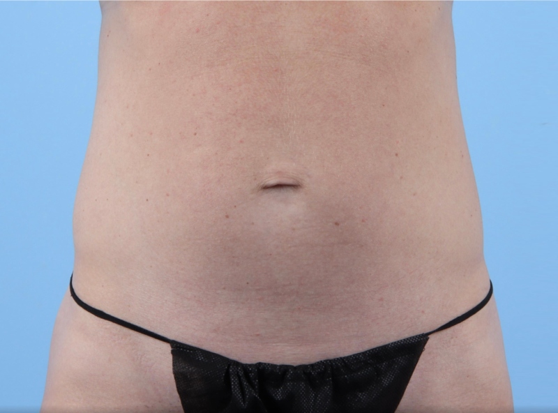 LipoAdbominoplasty Before & After Image