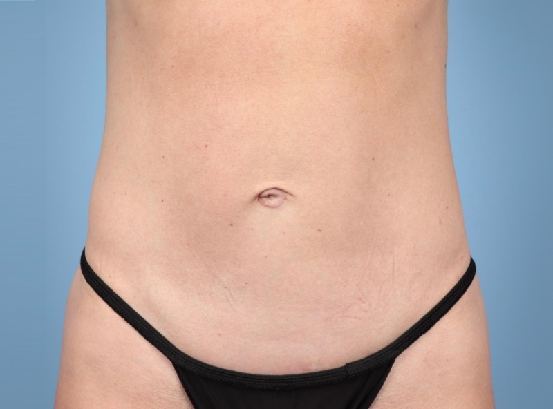 LipoAdbominoplasty Before & After Image