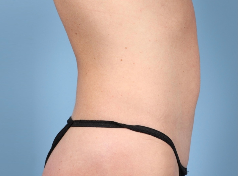 LipoAdbominoplasty Before & After Image