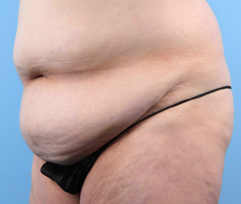 LipoAdbominoplasty Before & After Image