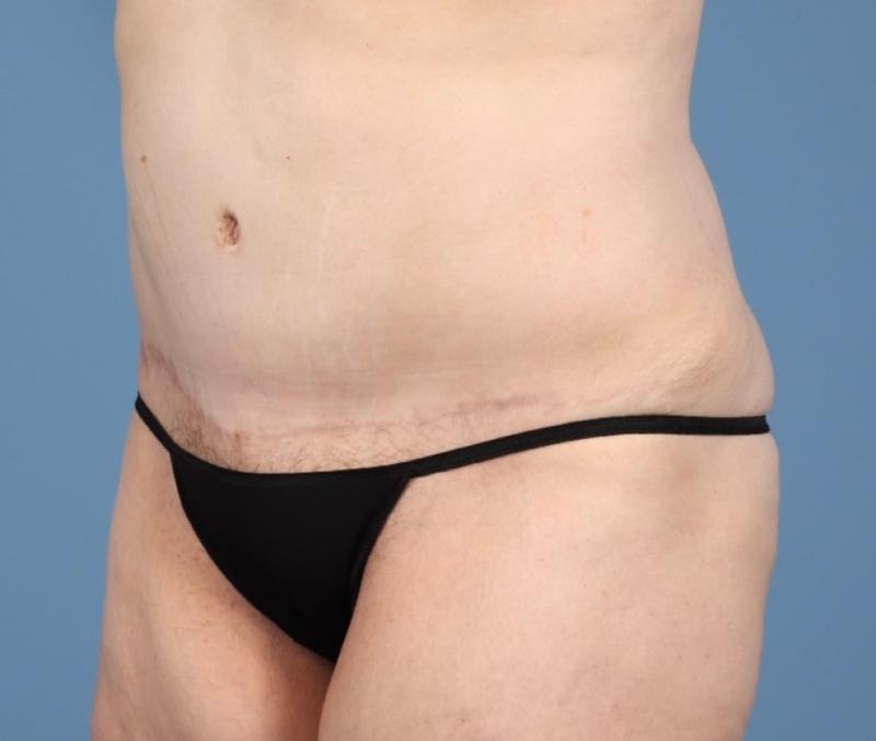 LipoAdbominoplasty Before & After Image