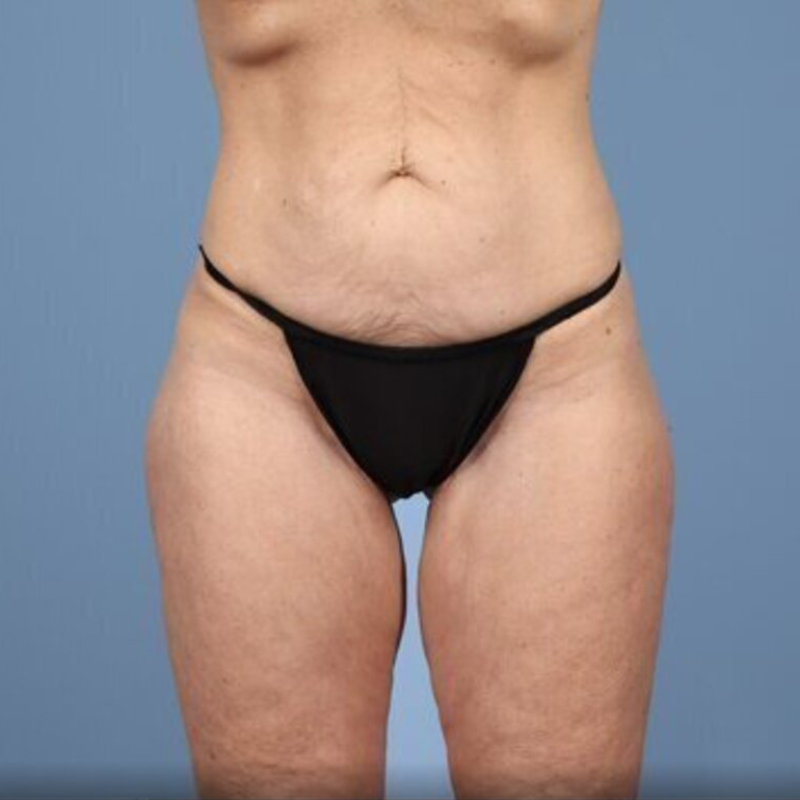 LipoAdbominoplasty Before & After Image