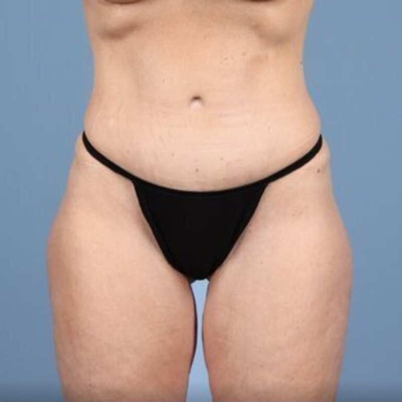LipoAdbominoplasty Before & After Image