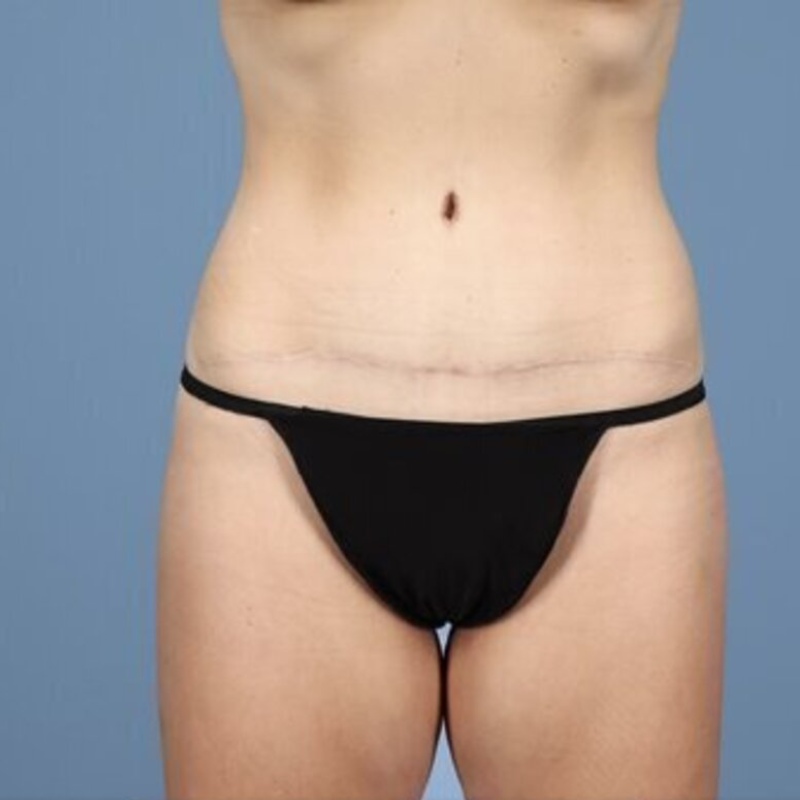 LipoAdbominoplasty Before & After Image