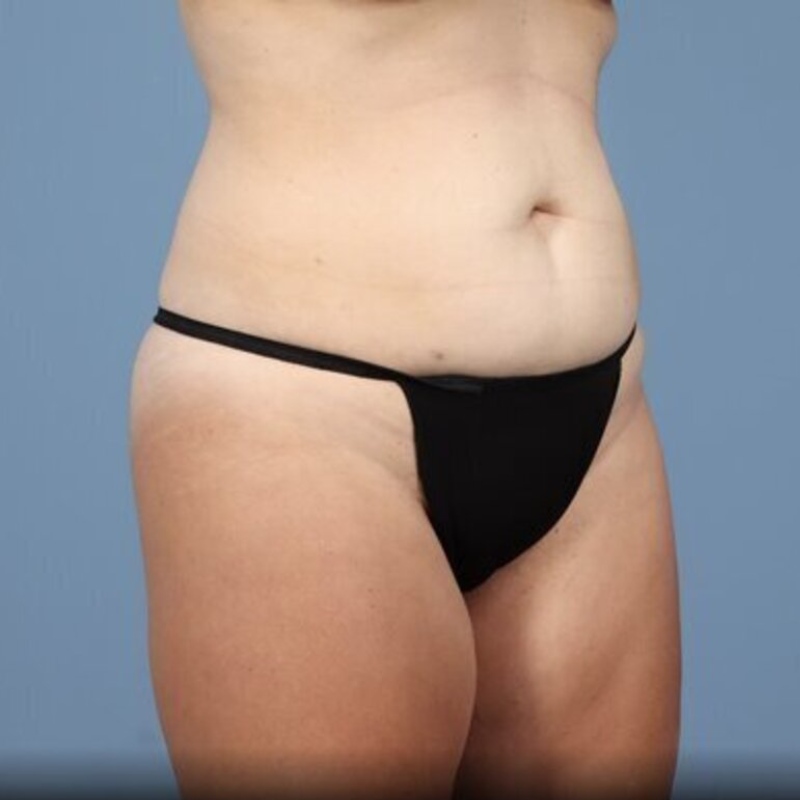 LipoAdbominoplasty Before & After Image