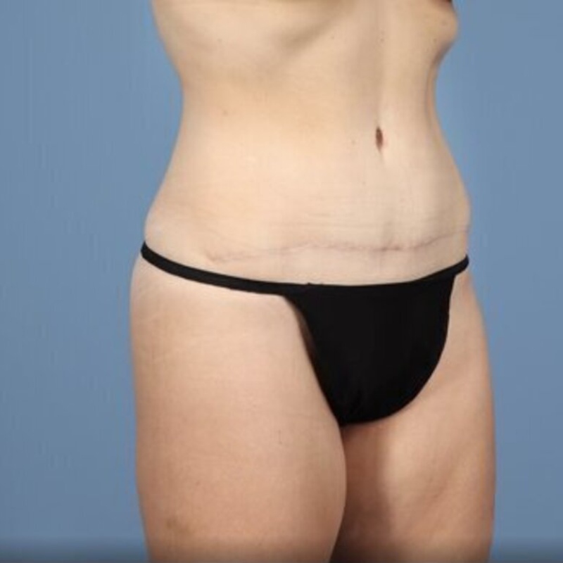 LipoAdbominoplasty Before & After Image
