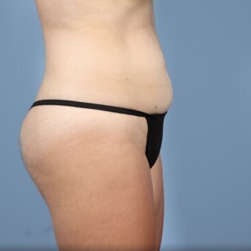 LipoAdbominoplasty Before & After Image