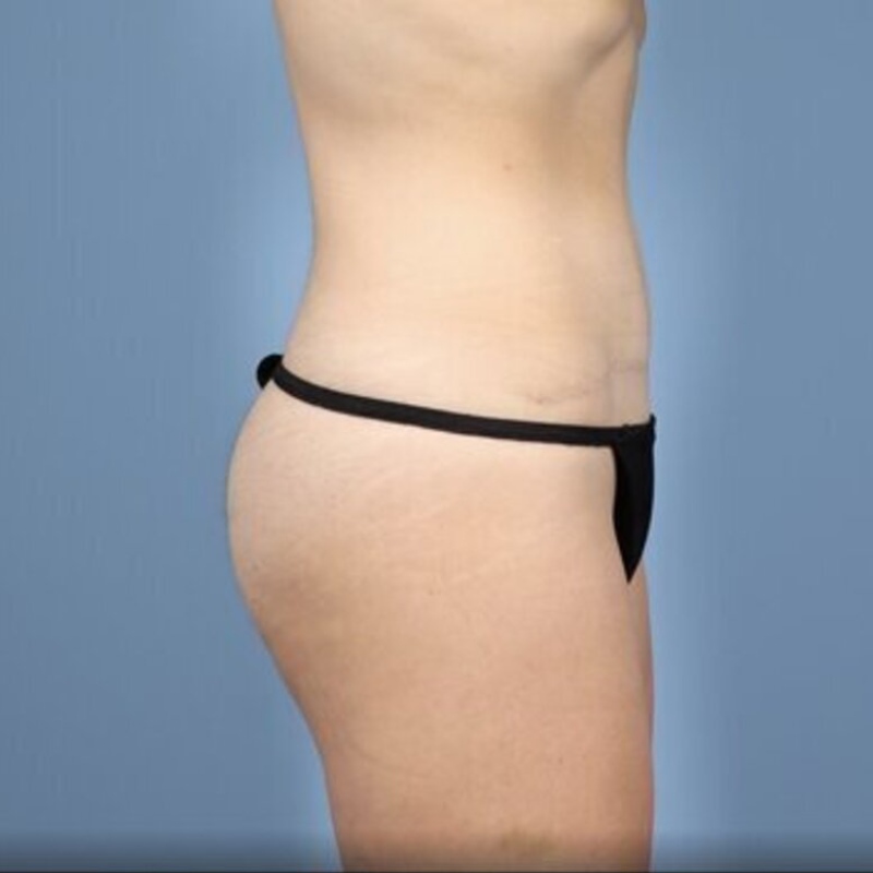LipoAdbominoplasty Before & After Image