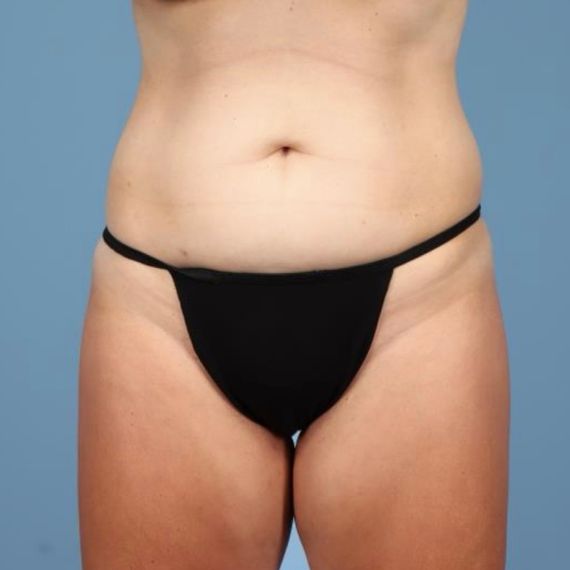 LipoAdbominoplasty Before & After Image