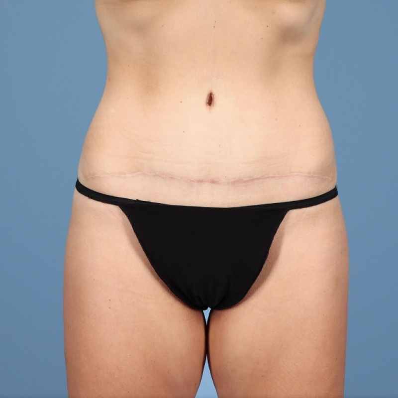 LipoAdbominoplasty Before & After Image