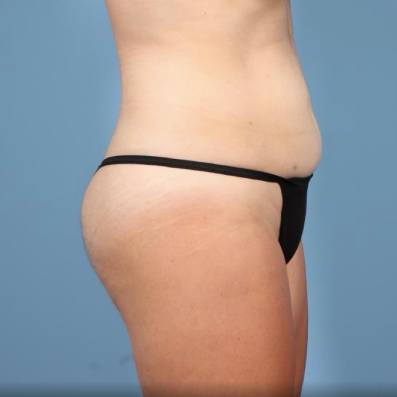 LipoAdbominoplasty Before & After Image