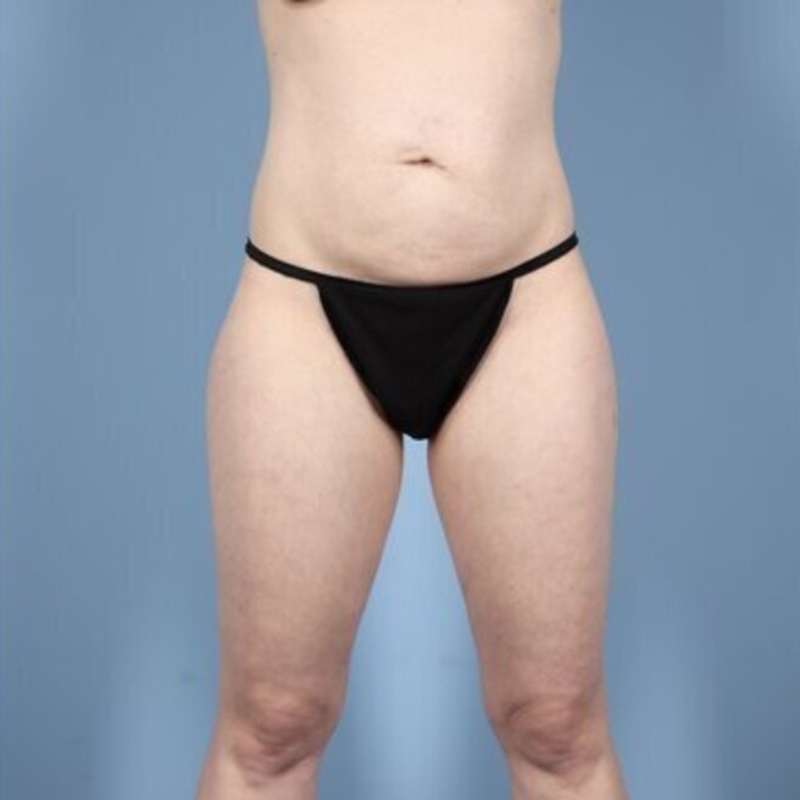 LipoAdbominoplasty Before & After Image