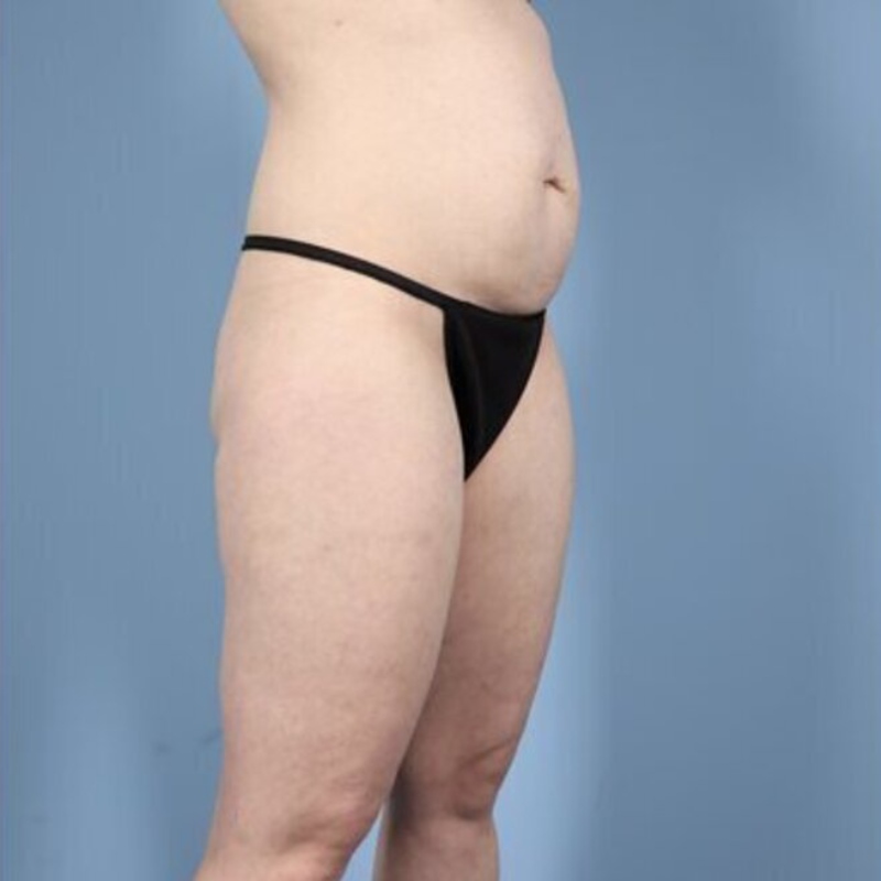 LipoAdbominoplasty Before & After Image