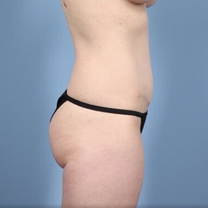 LipoAdbominoplasty Before & After Image