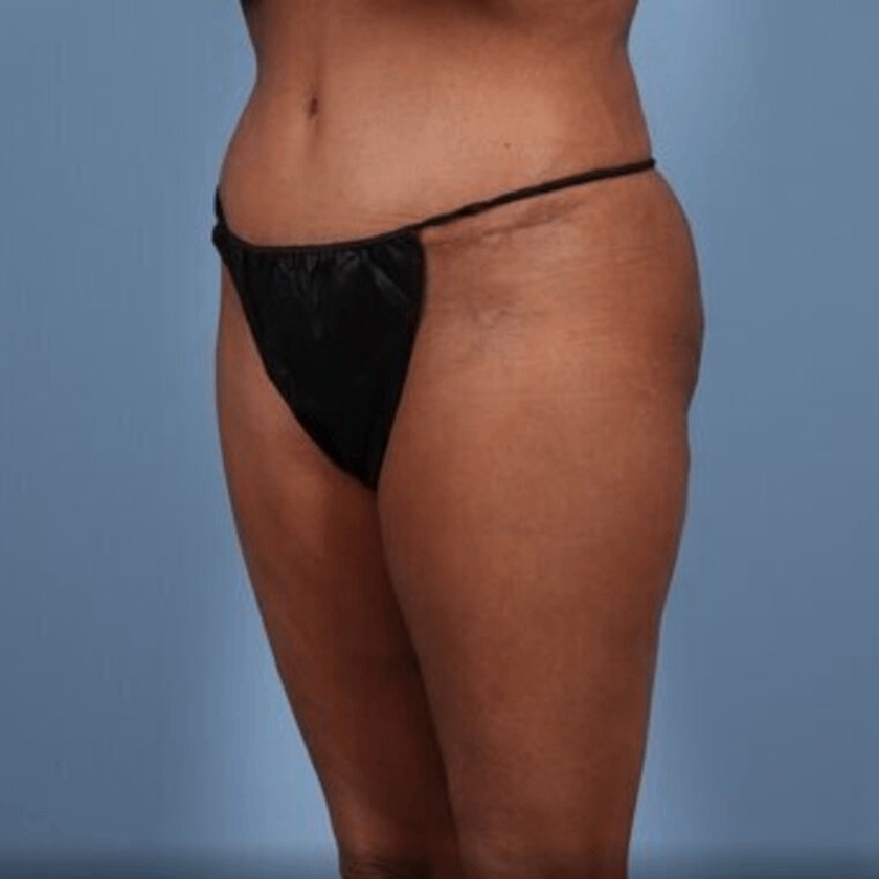 LipoAdbominoplasty Before & After Image