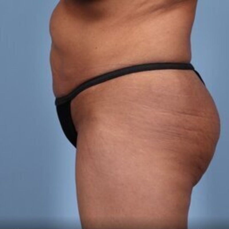 LipoAdbominoplasty Before & After Image