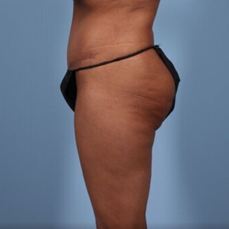 LipoAdbominoplasty Before & After Image