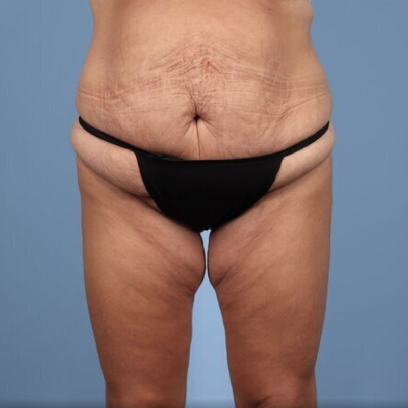 LipoAdbominoplasty Before & After Image