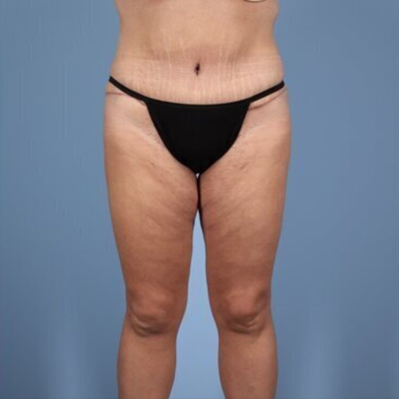 LipoAdbominoplasty Before & After Image