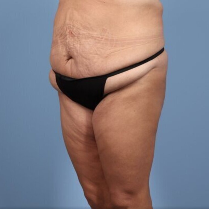 LipoAdbominoplasty Before & After Image
