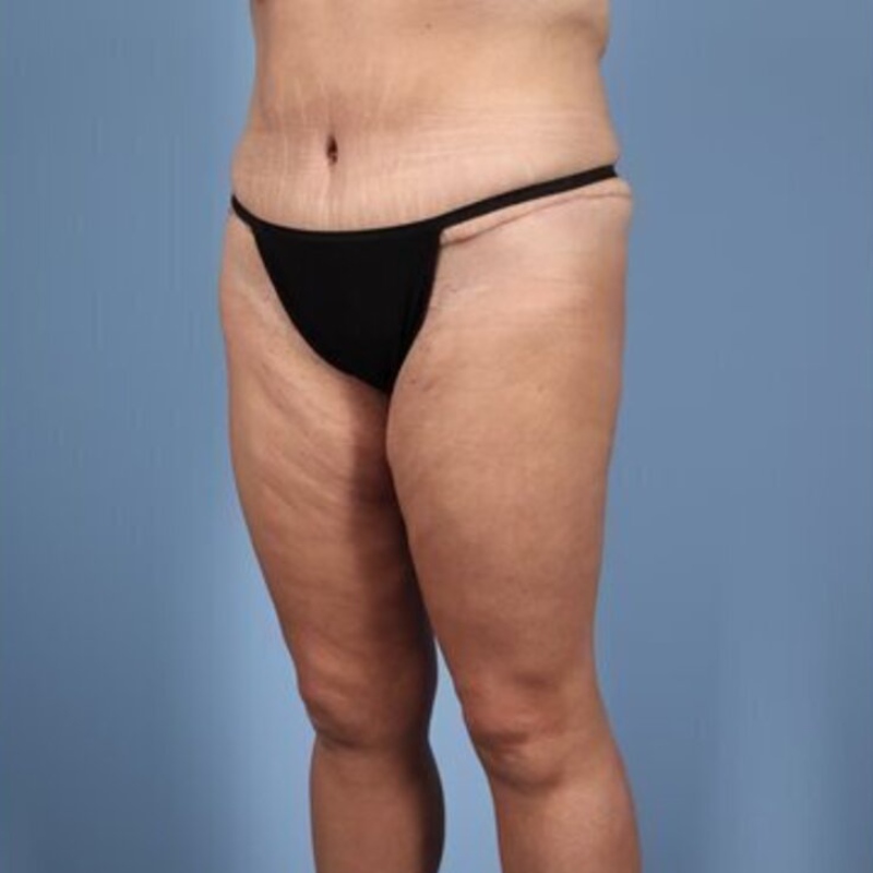 LipoAdbominoplasty Before & After Image