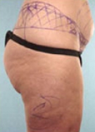 Liposuction Before & After Image