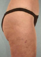 Liposuction Before & After Image