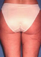 Liposuction Before & After Image