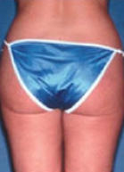 Liposuction Before & After Image