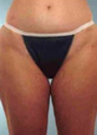 Liposuction Before & After Image