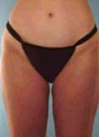 Liposuction Before & After Image