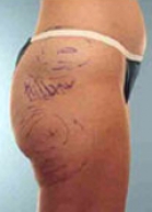 Liposuction Before & After Image