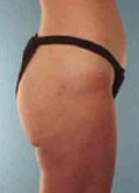 Liposuction Before & After Image