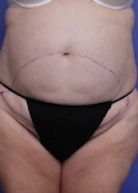 Liposuction Before & After Image