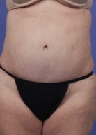 Liposuction Before & After Image