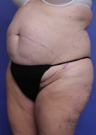 Liposuction Before & After Image