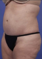 Liposuction Before & After Image