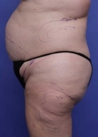 Liposuction Before & After Image