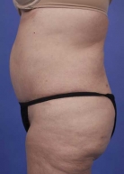 Liposuction Before & After Image