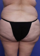 Liposuction Before & After Image