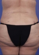 Liposuction Before & After Image