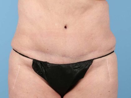 Liposuction Before & After Image