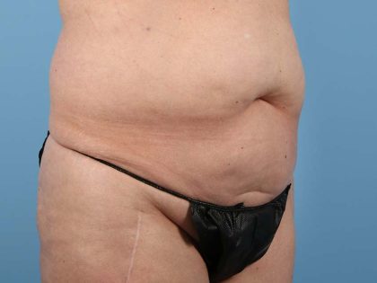 Liposuction Before & After Image