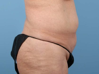 Liposuction Before & After Image