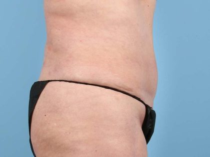 Liposuction Before & After Image