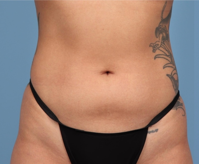 Liposuction Before & After Image
