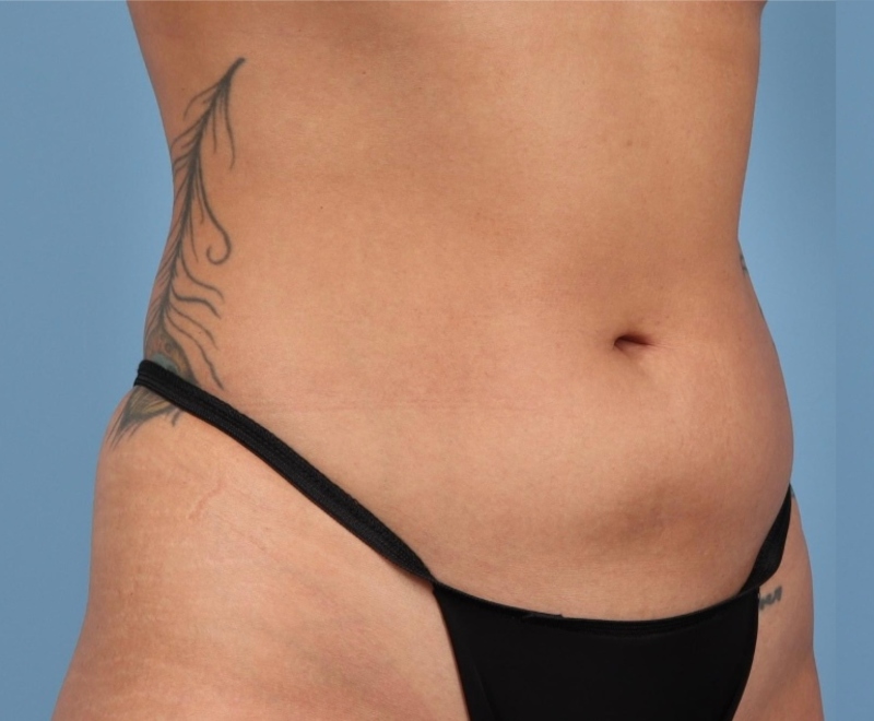Liposuction Before & After Image