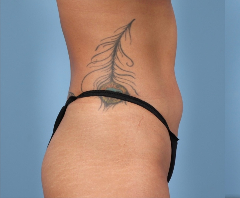 Liposuction Before & After Image