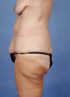 Lower Body Lift Before & After Image