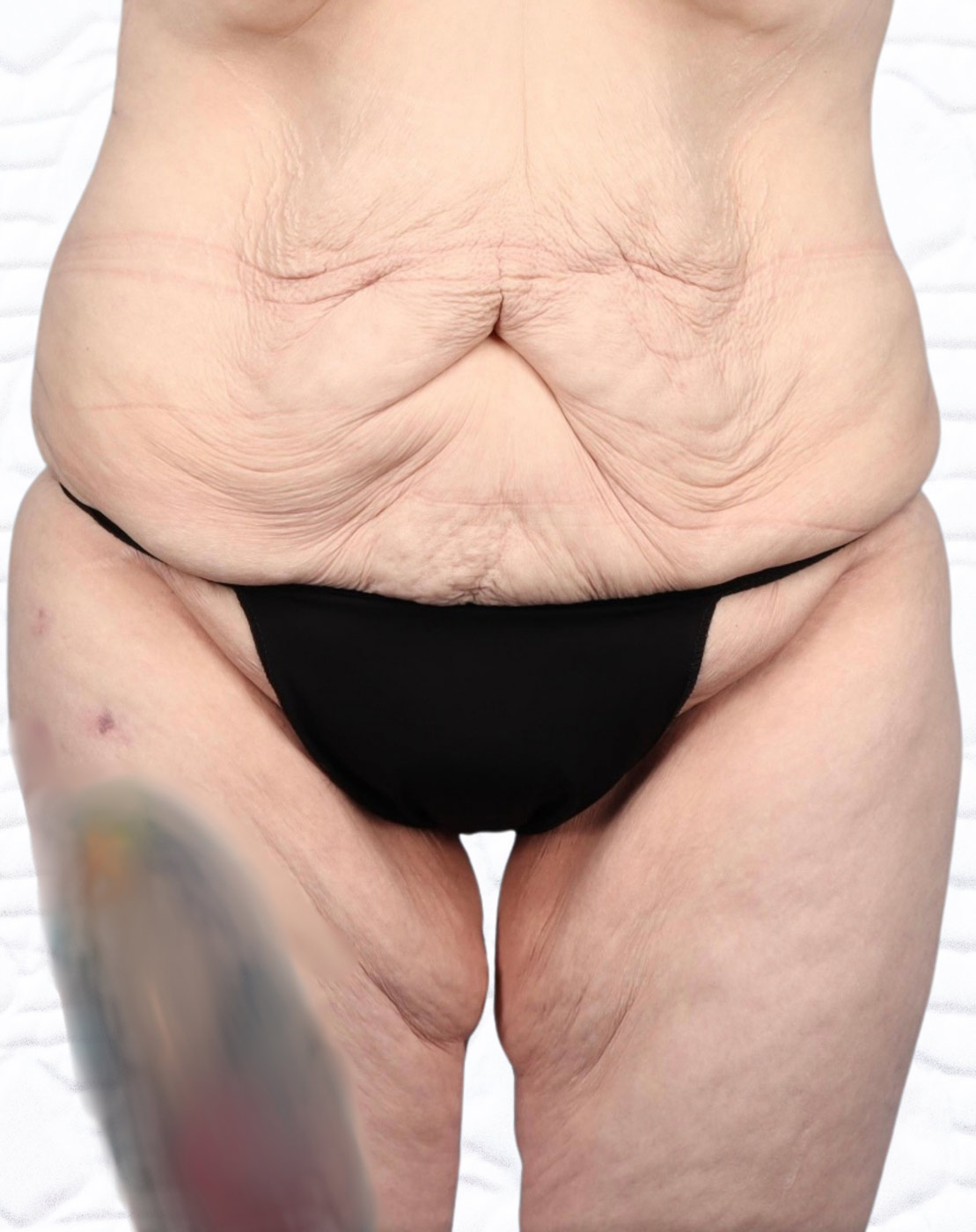 Lower Body Lift Before & After Image